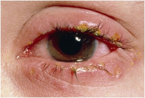 Bệnh đau mắt đỏ: nguyên nhân, phòng và trị bệnh đau mắt hiệu quả