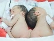 Hai bé song sinh dính liền mông ở Bình Phước 1 tháng nữa sẽ mổ