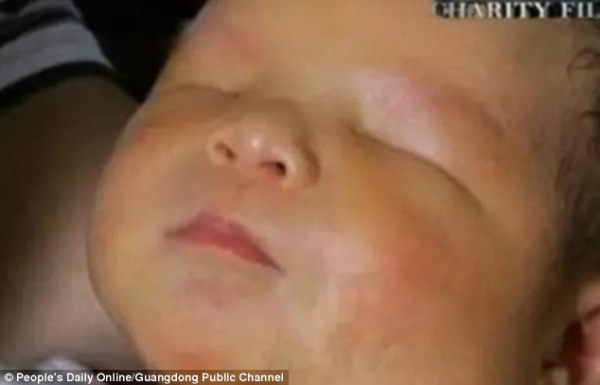 Em bé hoàn toàn không có mắt chào đời ở Trung Quốc