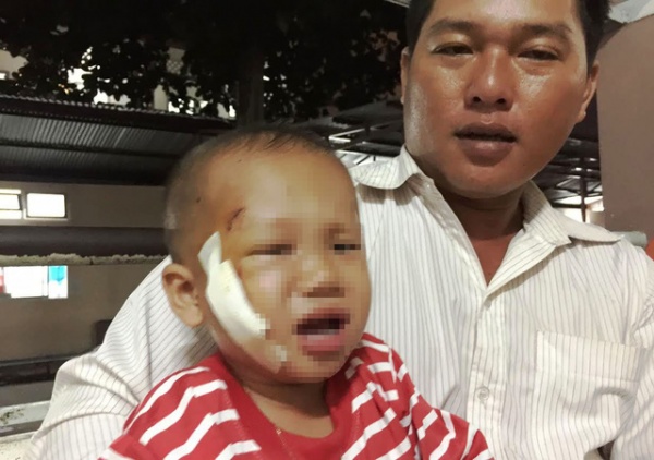 Té “cầu khỉ”, bé trai 3 tuổi bị cây đâm xuyên mặt