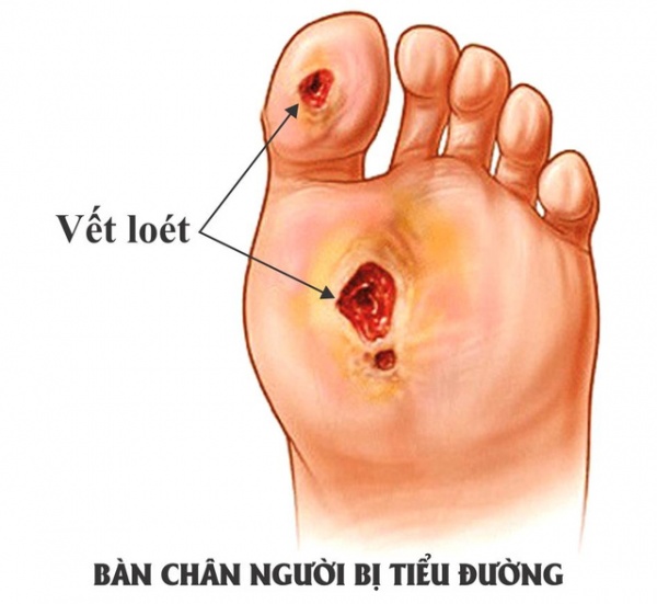 Cảnh báo dấu hiệu tê bì chân tay ở bệnh nhân tiểu đường