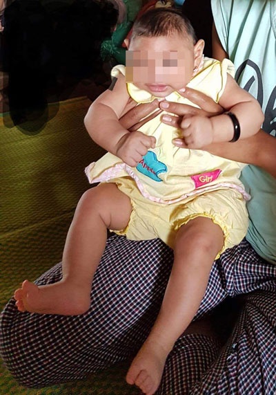 Bé gái 4 tháng tuổi ở Đắk Lắc bị dị tật do virus Zika
