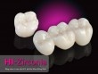 Nha Khoa Đông Nam ra mắt răng sứ cao cấp HI–Zirconia.