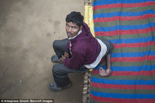 Chàng trai có 4 chân ở Ấn Độ