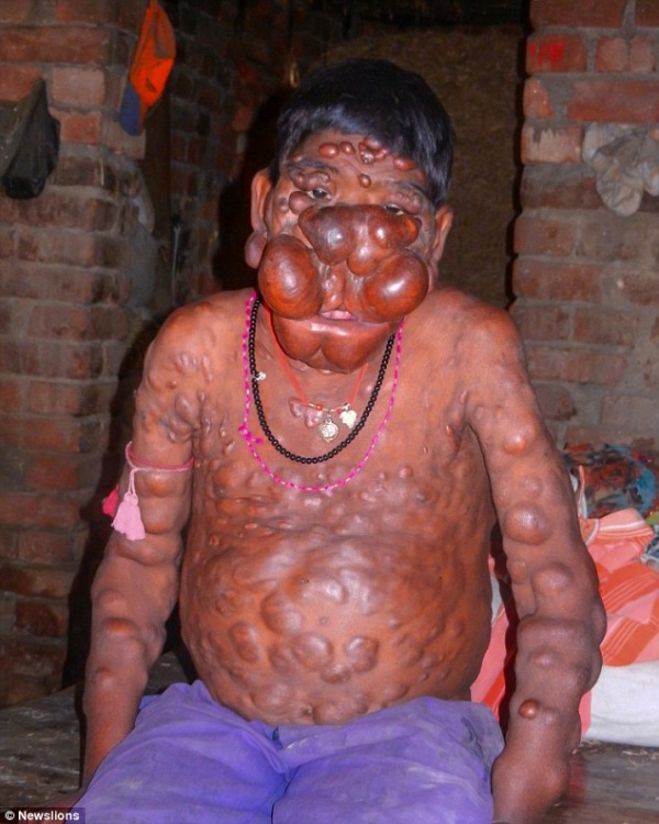 Cậu bé có khuôn mặt "ác quỷ" ở Ấn Độ
