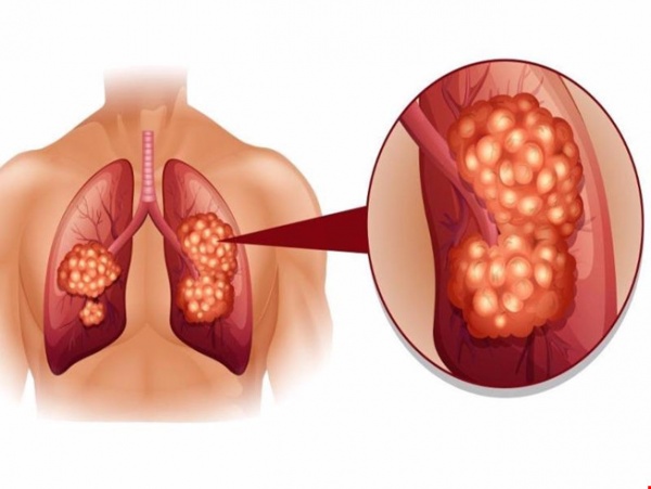 Những dấu hiệu không ngờ của bệnh ung thư phổi