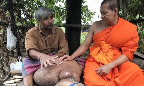Người đàn ông "chân voi" ở Thái Lan