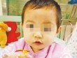 Bé gái hơn 1 tuổi bị đũa chọc vào mắt khi tự cầm đũa vừa ăn vừa chơi