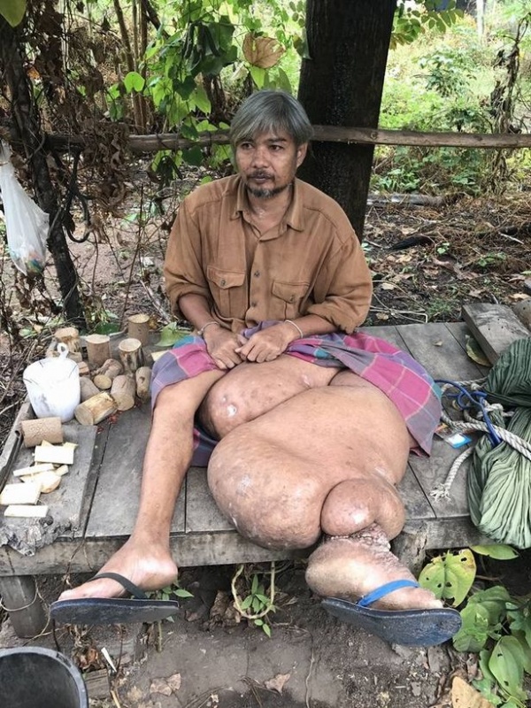 Người đàn ông Thái Lan khốn khổ vì chân to như voi