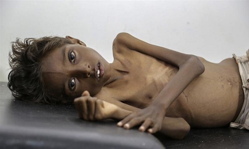 Bé 5 tuổi gầy trơ xương vì đói ăn ở Yemen