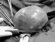 Nghệ An: Cắt bỏ khối u nặng 2,5kg từ tử cung một phụ nữ bị dị tật