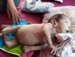 Xót thương bé gái 6 tháng tuổi nặng 3,2kg, không lên lạng nào từ lúc sinh ra
