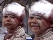 Hình ảnh bé gái mỉm cười dù đầu bị băng kín do trúng bom khiến người xem bật khóc