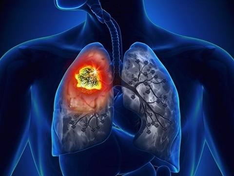 Những dấu hiệu cảnh báo ung thư phổi không thể bỏ qua