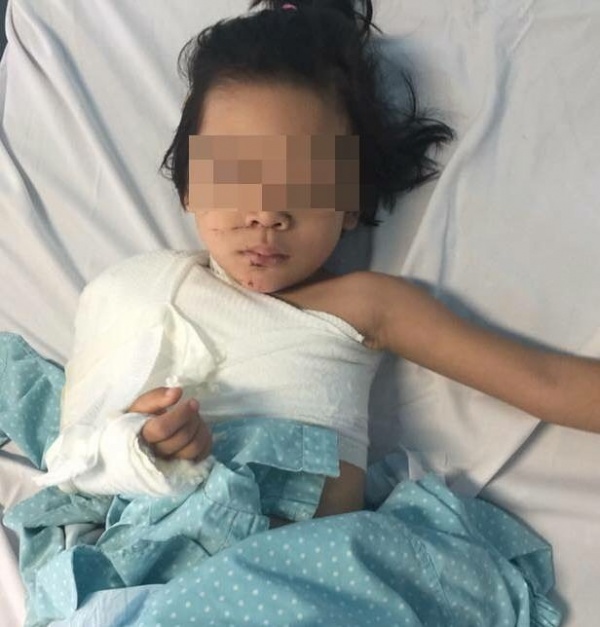Nối thành công cánh tay bé gái 5 tuổi bị dập nát sau tai nạn giao thông