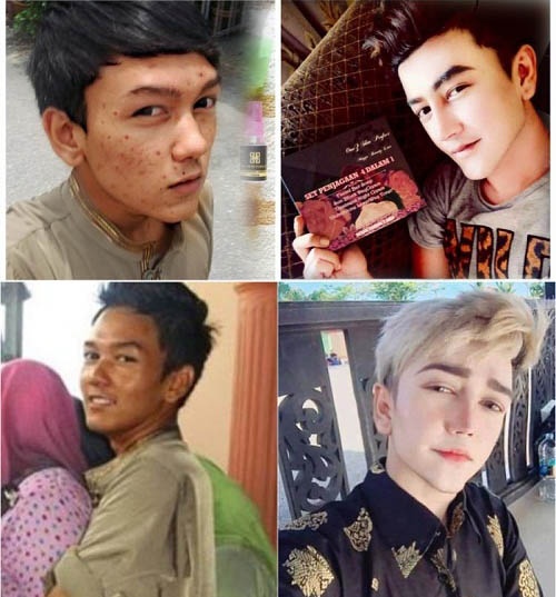 Sốc vì mặt mụn chi chít trước "dao kéo" của hot boy Malaysia
