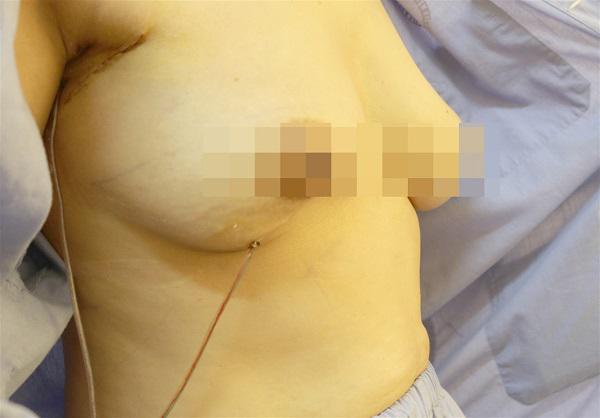 Phát hiện ngực có hòn khi tắm, đi khám người phụ nữ phát hiện mắc ung thư