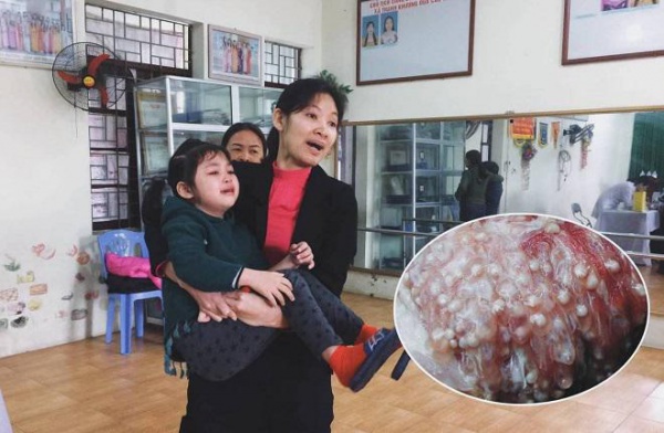 Nóng: Cả giáo viên trường mầm non ở Bắc Ninh cũng nhiễm sán lợn gạo