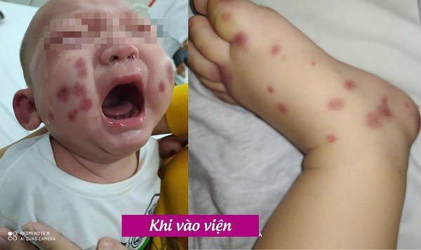Sốt 1 ngày đi khám, bé trai 6 tháng tuổi phát hiện mắc bệnh chưa từng có tại Việt Nam