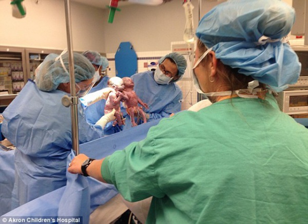 Hai bé gái sinh đôi nắm chặt tay nhau lúc chào đời, giờ lớn khó ai nhận ra