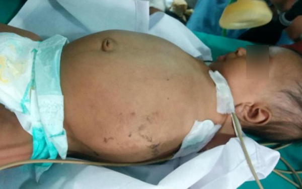 Con gái 9 tháng tuổi bụng ngày một to dần, kết quả siêu âm khiến người mẹ ngã ngửa