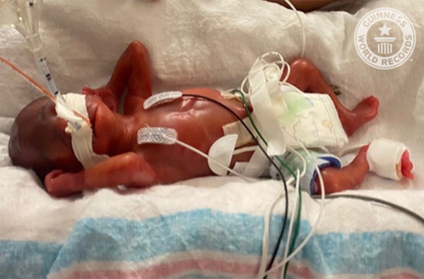 Hình ảnh mới nhất về bé sơ sinh nặng 4 lạng, bác sĩ từng phán không có cơ hội sống