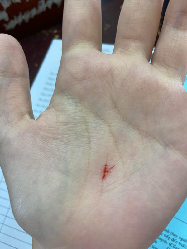 TP.HCM: Dùng compa đâm chảy máu tay học sinh vì làm sai quy tắc bàn tay trong giờ Vật lý