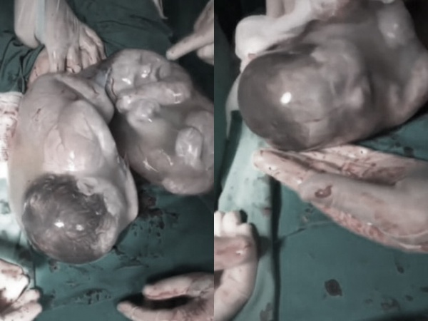 Hiếm có khó tìm: Cặp sinh đôi chào đời trong bọc ối còn nguyên, cựa mãi không ra được