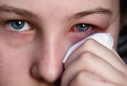 Cách tránh lây nhiễm đau mắt đỏ khi bùng nổ dịch