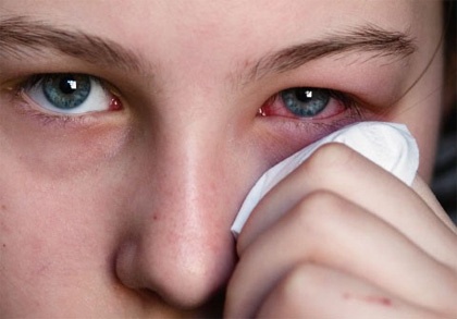 Mẹo chữa đau mắt đỏ hữu hiệu bằng khoai tây và mật ong
