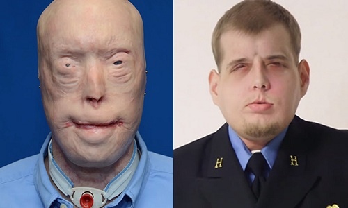 Lính cứu hỏa lột xác kỳ diệu sau ca ghép mặt