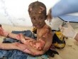 Chấn động hình ảnh em bé napalm Syria bỏng nặng