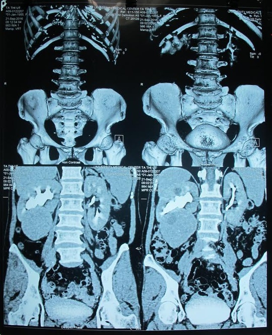 Đau bụng cả năm, phát hiện thì đã... u thận