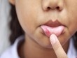 6 cách tự nhiên chữa lở miệng