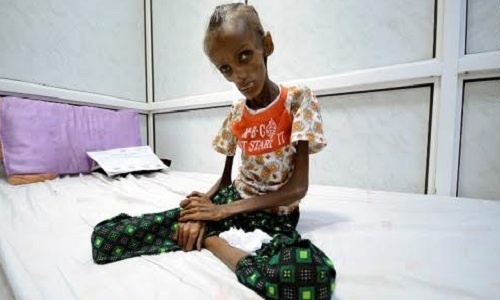 Thiếu nữ 18 tuổi gầy trơ xương vì đói ăn ở Yemen
