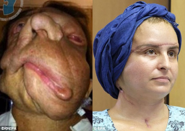 Trả lại khuôn mặt cho người phụ nữ bị khối u khổng lồ