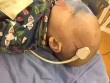Ngã từ giường xuống đất, bé trai 2 tuổi bị phích điện cắm xiên vào não