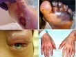 Bị biến chứng cụt chân, mù mắt vì căn bệnh xuất phát từ ăn uống mà ra