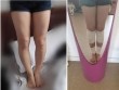Bị chê “nấm lùn”, cô gái trẻ quyết định mạo hiểm phẫu thuật kéo dài chân