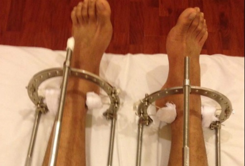 Hotboy Hà Nội tiết lộ ảnh kéo dài chân đau đớn để cao lên 1m76