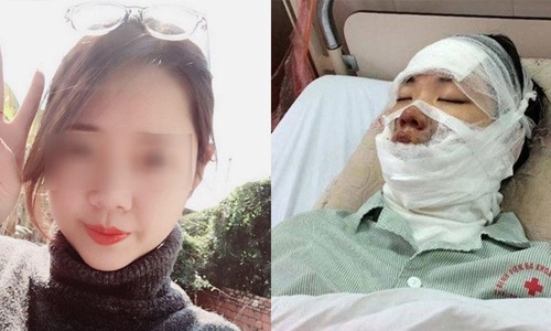 Cô gái Hà Nội bỏng toàn bộ mặt vì nổ 55 quả bóng bay