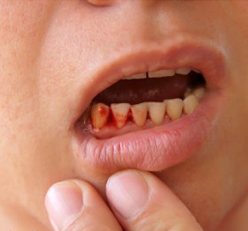 Mệt mỏi, chảy máu chân răng: dấu hiệu của bệnh cực kỳ nguy hiểm