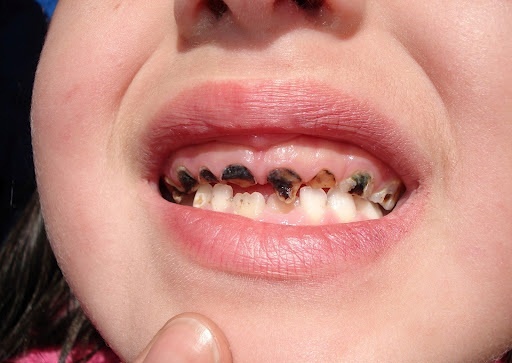 Ðừng để sâu răng gây hậu quả đáng tiếc cho trẻ