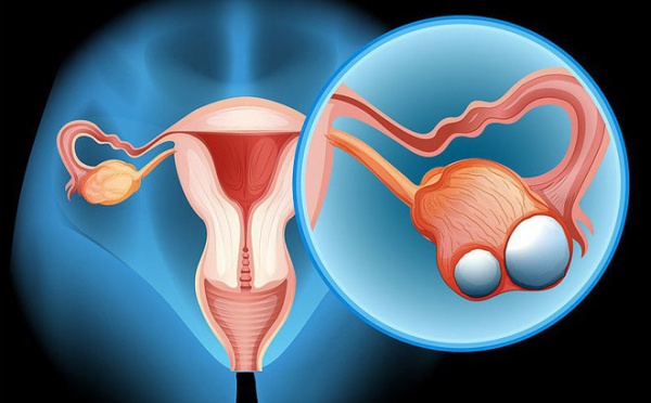Thuốc tránh thai làm giảm nguy cơ ung thư buồng trứng