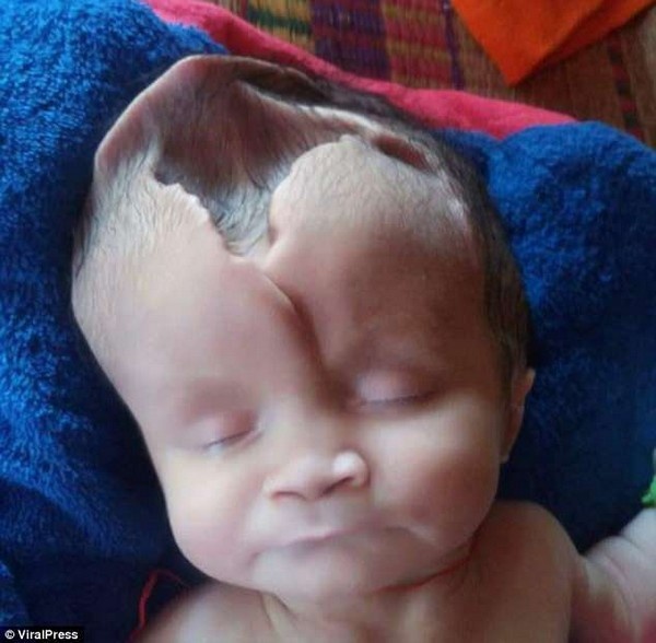Đáng thương em bé chào đời với đầu biến dạng vì không có hộp sọ