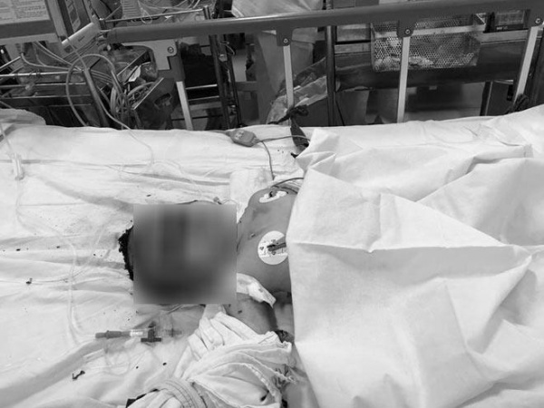 Mẹ bầu và con 15 tháng tuổi bị bỏng nguy kịch do bình gas phát nổ khi đang nấu ăn