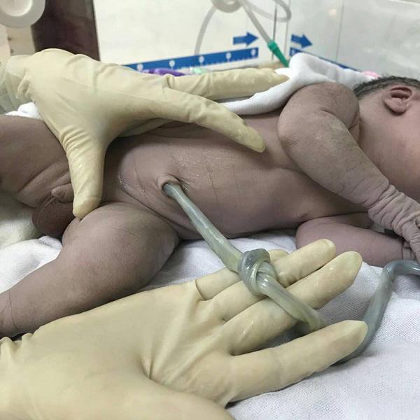 Thai phụ suýt mất con 3.1kg chỉ vì... muốn đẻ thường trong lần sinh đầu tiên