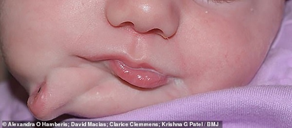 Bé gái sinh ra với chiếc miệng thứ 2 ngay dưới cằm, có đủ môi, răng, lưỡi giờ ra sao?