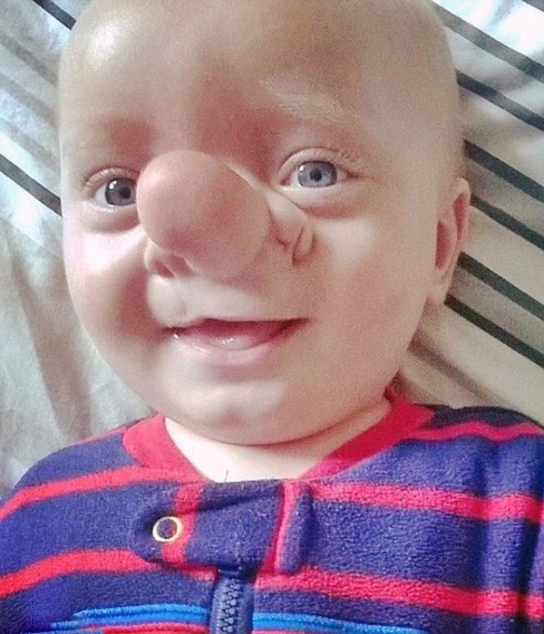 Cậu bé sinh ra với chiếc mũi to dài dị dạng, được gọi là Pinocchio giờ ra sao?