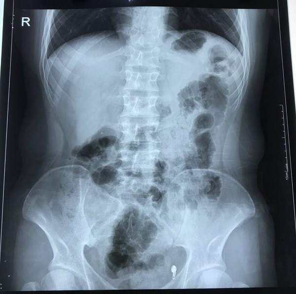Thanh niên Hà Nội đau ruột thừa, vào viện bác sĩ bất ngờ khi thấy nội tạng quá khác thường